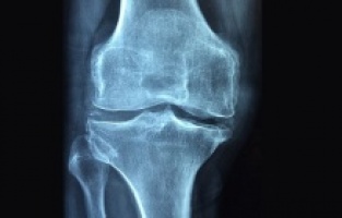 Romatoid artrit hastalığı yokmuşçasına yaşamak artık mümkün olabiliyor