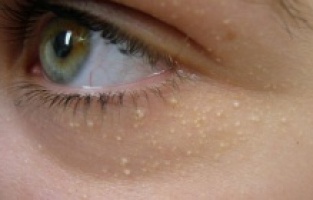 Milia (Yüzdeki beyaz noktalar) nedir ve neden olur?
