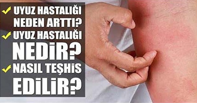 Uyuzun belirtileri nelerdir, hangi bölgelerde görülür?