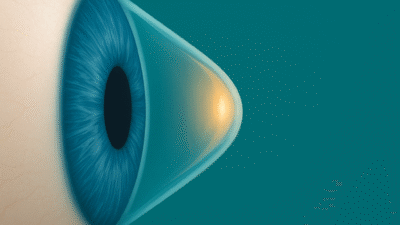 Gözün ön kısmında yer alan kornea tabakasının incelmesi ve öne