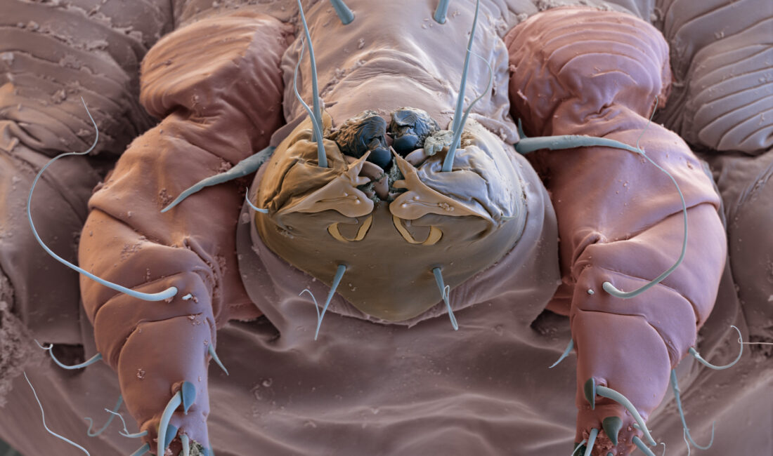 Son dönemde dermatoloji kliniklerine yapılan başvurularda uyuz (scabies) vakalarında yeniden