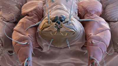 Son dönemde dermatoloji kliniklerine yapılan başvurularda uyuz (scabies) vakalarında yeniden