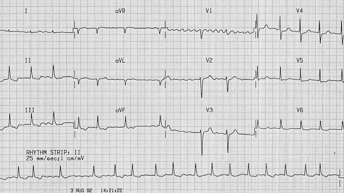 Çarpıntının Arkasındaki Sessiz Tehlike: Atriyal Fibrilasyon Kalbimiz, yaşam boyu hiç durmadan çalışan bir motor gibidir. Dakikada