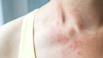 Nadir görülen genetik bir hastalık olan Nörofibromatozis Tip 1 (NF1)