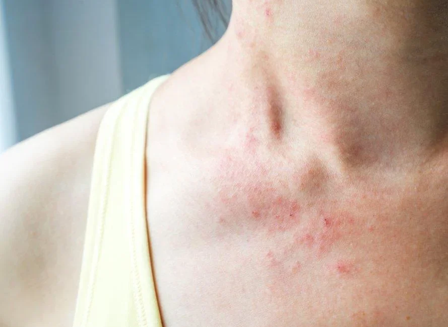 Nadir görülen genetik bir hastalık olan Nörofibromatozis Tip 1 (NF1)