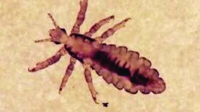 Saç biti (Pediculus humanus capitis) vakaları dünya genelinde yeniden yükselişte.