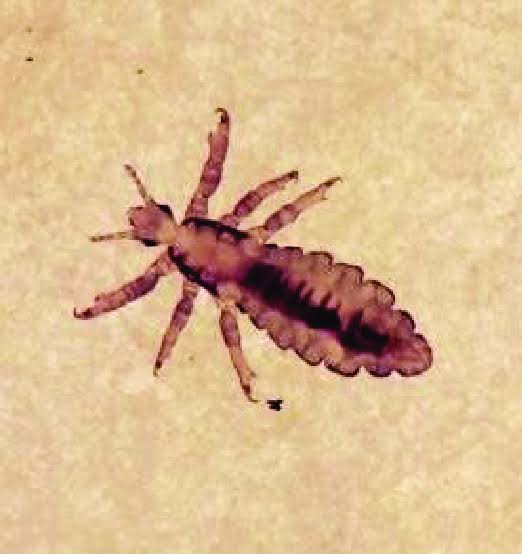 Saç biti (Pediculus humanus capitis) vakaları dünya genelinde yeniden yükselişte.