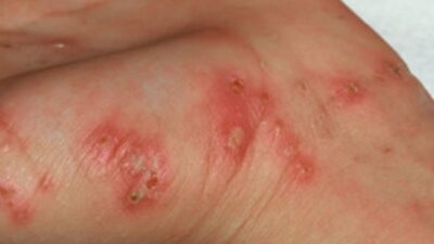 Türkiye’de ve dünyada yeniden artış eğilimi gösteren uyuz (scabies) hastalığı,