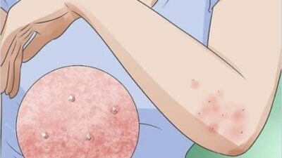 Kış aylarıyla birlikte Türkiye’nin birçok bölgesinde uyuz vakaları dikkat çekmeye