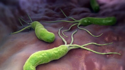 Dünya nüfusunun yaklaşık yarısının taşıdığı düşünülen Helicobacter pylori, ülserden gastrite