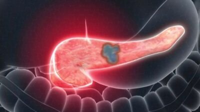 GLP-1 sınıfı zayıflama iğneleri (semaglutid, liraglutid, dulaglutid, tirzepatid) dünya çapında