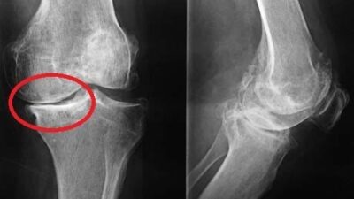 Diz kireçlenmesi artık yalnızca yaşlılık sorunu değil. 40 yaşından itibaren